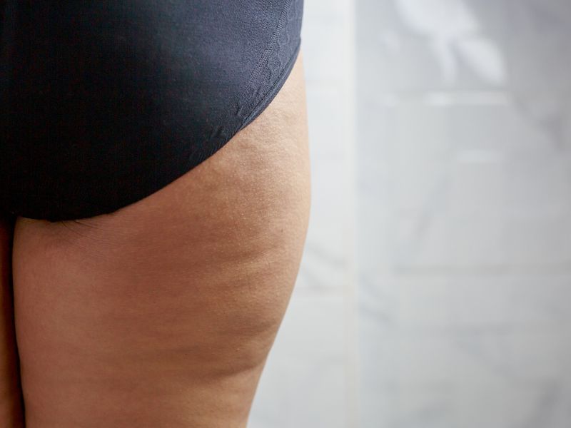 Lipedema Causas Sintomas e Por Que Nao E Sua Culpa
