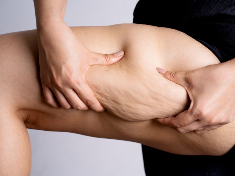 Tratamentos Eficazes para Celulite